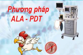 Điều trị sùi mào gà bằng phương pháp ALA-PDT hiệu quả