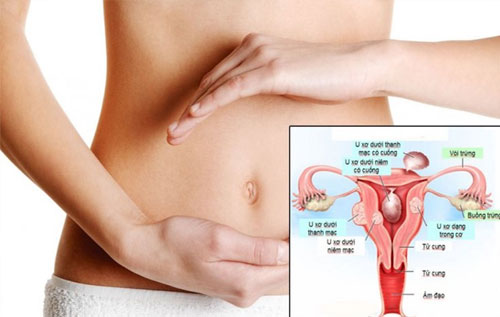 Triệu chứng của bệnh u xơ tử cung nữ giới là gì?